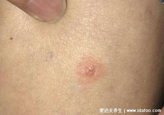 真人蛇盘疮初期图片展示,呈带状分布的小水疱有剧烈神经痛