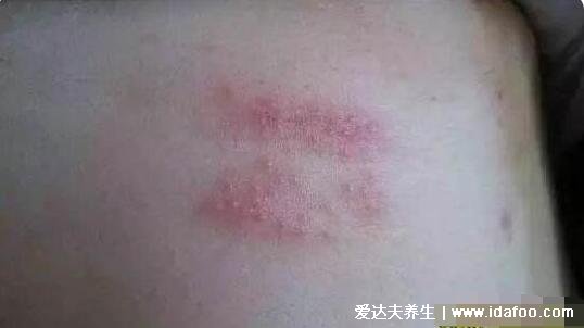 真人蛇盘疮初期图片展示,呈带状分布的小水疱有剧烈神经痛