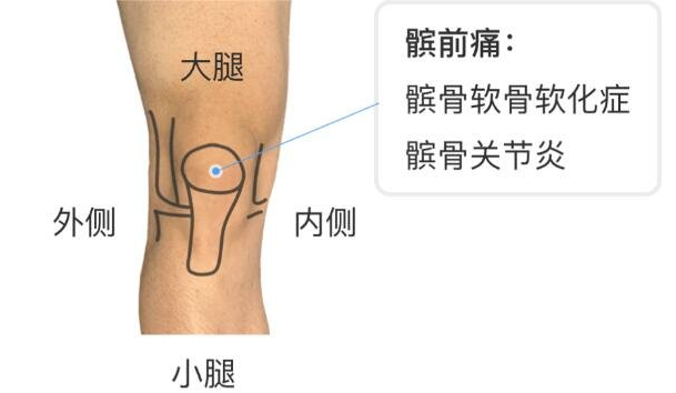 髌骨是哪个部位图片,人膝盖各个部位疼痛图解(膝盖正中心)