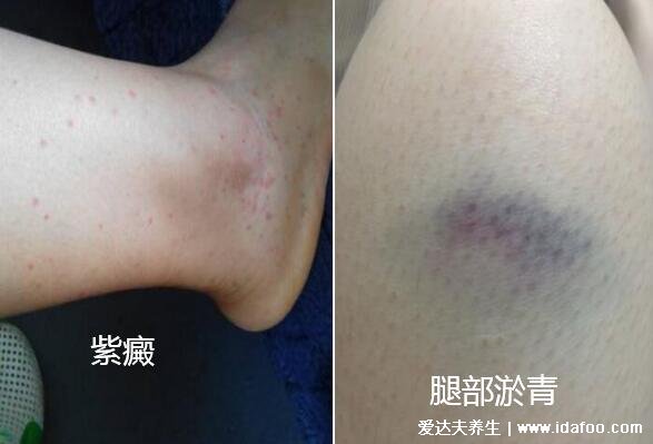 紫癜和淤青的区别图片,紫癜出血点面积小是紫红色扁平丘疹有痛痒感