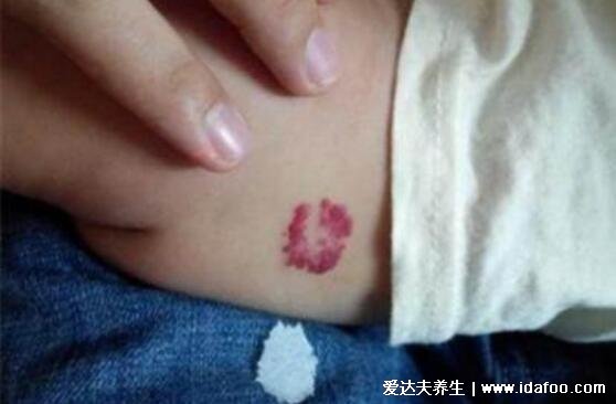 毛细血管瘤早期图片,警惕按压会褪色的鲜红斑块