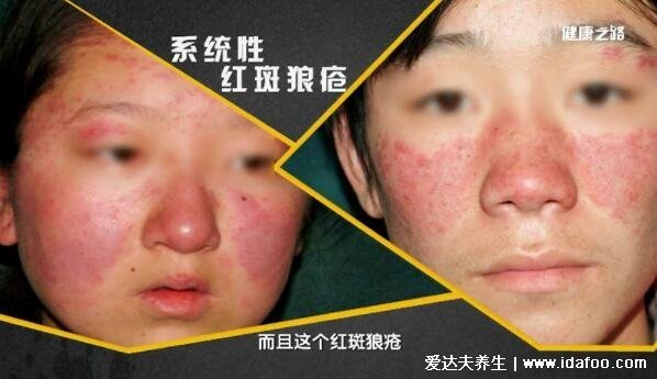 红疮狼斑早期图片及症状,两颊长对称的蝴蝶型红斑有灼痛感