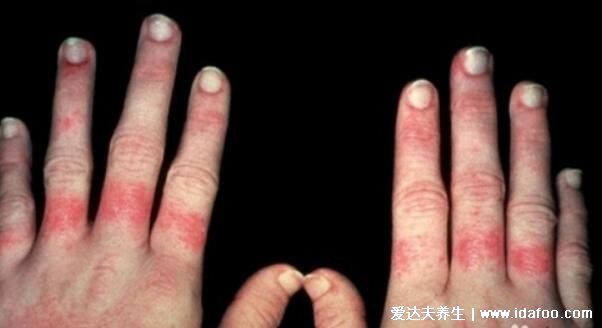 红疮狼斑早期图片及症状,两颊长对称的蝴蝶型红斑有灼痛感