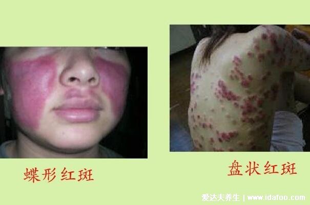 红疮狼斑早期图片及症状,两颊长对称的蝴蝶型红斑有灼痛感