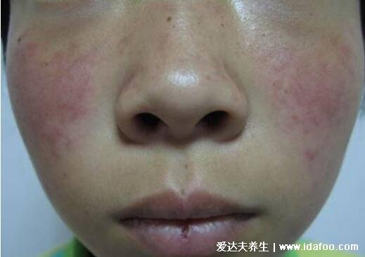 红疮狼斑早期图片及症状,两颊长对称的蝴蝶型红斑有灼痛感