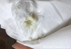 豆腐渣样白带图片,伴随下体瘙痒有异味警