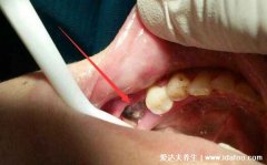 干槽症早期症状图片，拔牙后3-5天痛感加剧