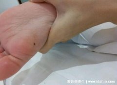 儿童黑色素痣初期图片,和普通痣有4点不同