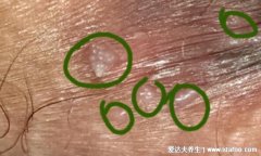 女性菜花状疣早期症状图片，米粒大小的疣