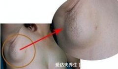 腋下淋巴结肿大图片,肿大症状以及形成原