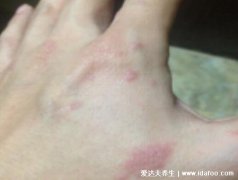 牛皮癣图片初期症状,中期晚期被称为不死