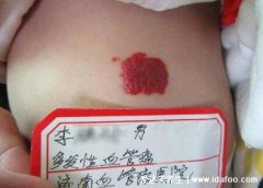 红色血管瘤是什么样的图片，宝宝有红色斑