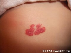 宝宝背上血管瘤图片，身体各个部位的血管