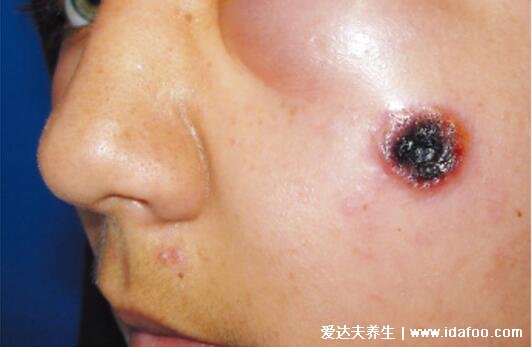 人感染炭疽病图片及症状,感染肺炭疽死亡率90%以上(三种类型)