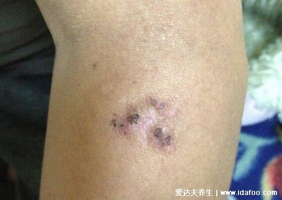 人感染炭疽病图片及症状,感染肺炭疽死亡率90%以上(三种类型)
