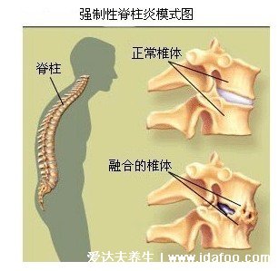 右后背痛病情对照图,需警惕四种病(女性更易得风湿)