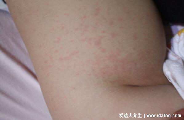 高烧退后的疹子图片,从脖子蔓延至全身的玫瑰色丘疹1-2天消失