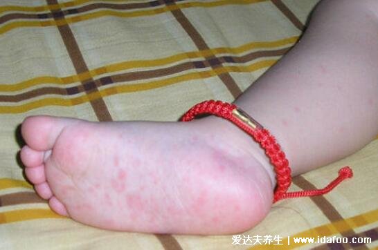 高烧退后的疹子图片,从脖子蔓延至全身的玫瑰色丘疹1-2天消失
