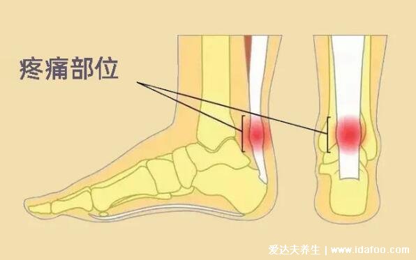 脚踝各个部位疼痛图解,脚踝后侧可能是跟腱炎(附脚底疼痛部位图解)