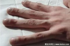 体内有癌手脚先知道，警惕手脚杵状指是肺