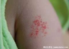 小孩血管瘤图片初期图片，警惕凸起的红色