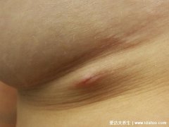 腋窝淋巴结肿大图片男,淋巴结凸起红块可