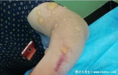 人感染炭疽病图片及症状,感染肺炭疽死亡