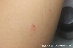 人得猫癣初期症状图片,像蚊子包一样的红