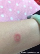 人得猫癣初期症状图片 ,人得了猫藓最有效