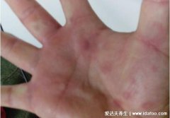 小孩手上长小红点图解，警惕白血病突出表