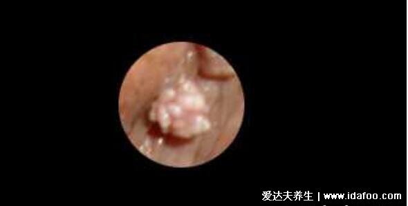 女性假疣和真疣的区别图,珍珠疹和菜花样尖锐湿疣一眼能分辨