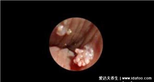 女性假疣和真疣的区别图,珍珠疹和菜花样尖锐湿疣一眼能分辨