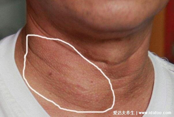 甲状腺的主要症状图片,警惕:明明吃的多体重却在下降