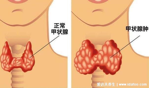 甲状腺的主要症状图片,警惕:明明吃的多体重却在下降