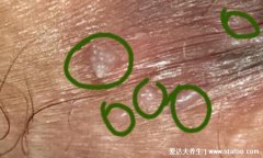 女性长出疣体初期图片，表面很脆柔软易出