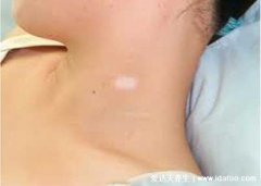 最真实白斑图片初期症状图片,白斑刚开始