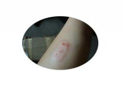 牛皮肤癣的症状图片，治疗牛皮肤癣的3种方