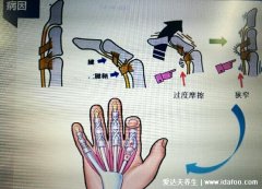 腱鞘炎最佳治疗方法大拇指关节疼痛,大拇