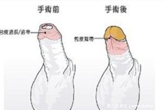 包茎手术20天恢复图片，建议4周后过X生活