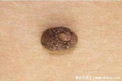 恶性黑色素瘤图片,和普通痣区别很大会致