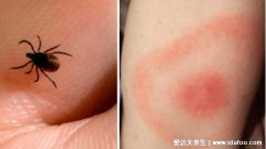 蜱虫咬人后有什么症状,真实蜱虫叮咬后伤