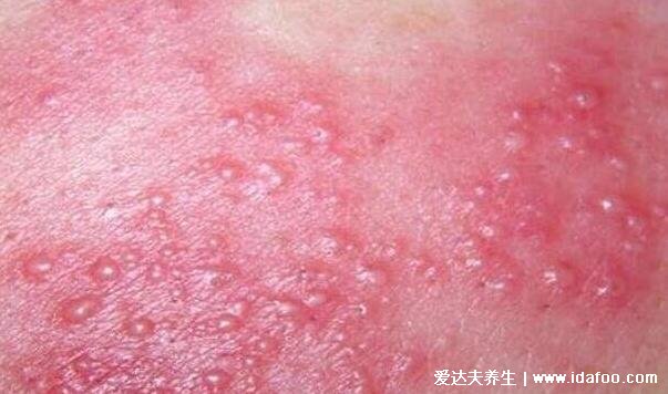 怎么判断是不是水痘,水痘的症状和图片(附7天演变过程图)