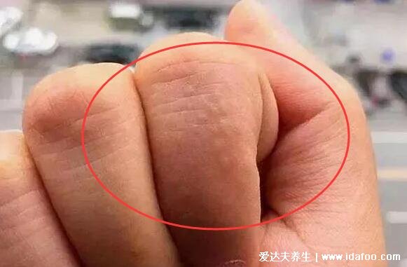 湿气重手上长水泡图片,密集的小水泡伴随瘙痒脱屑(附祛湿方法)