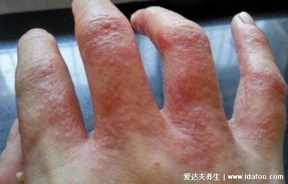 湿气重手上长水泡图片,密集的小水泡伴随瘙痒脱屑(附祛湿方法)