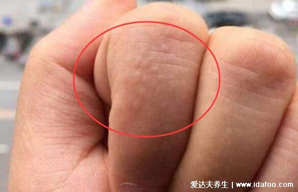 湿气重手上长水泡图片,密集的小水泡伴随瘙痒脱屑(附祛湿方法)