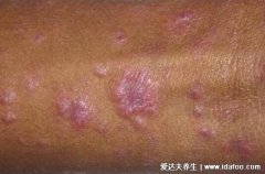 梅毒小红点早期图,不痛不痒的从生殖器蔓