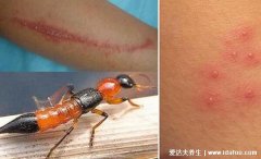 隐翅虫咬人后图片及症状,毒液在隐翅虫体