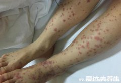 紫癜是一种什么病，出血性疾病附紫癜的早