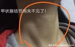 甲状腺结节会自愈吗,炎症或增生性的结节