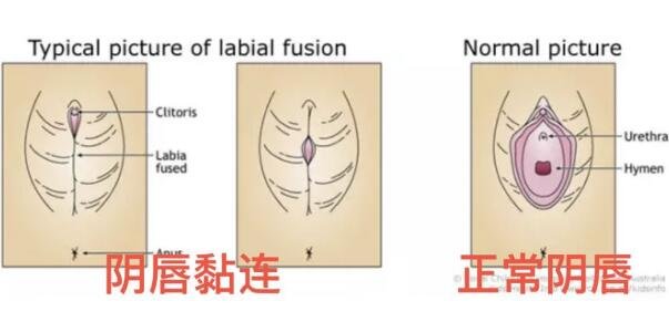 外阴白斑是什么症状图片,皮肤像树皮伴随剧烈的瘙痒灼痛感